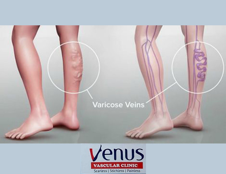 VENUS VASCULAR CLINIC ( TALAP )